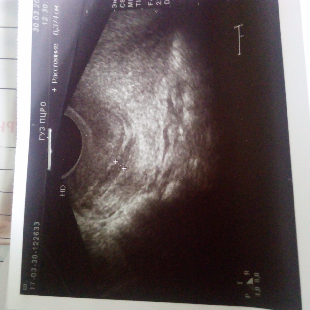 Неделя после зачатия узи. УЗИ беременности 4 недели беременности. Снимки УЗИ на 2 неделе беременности. Беременность на 2-3 недели беременности на УЗИ. УЗИ 1.5 недели беременности.