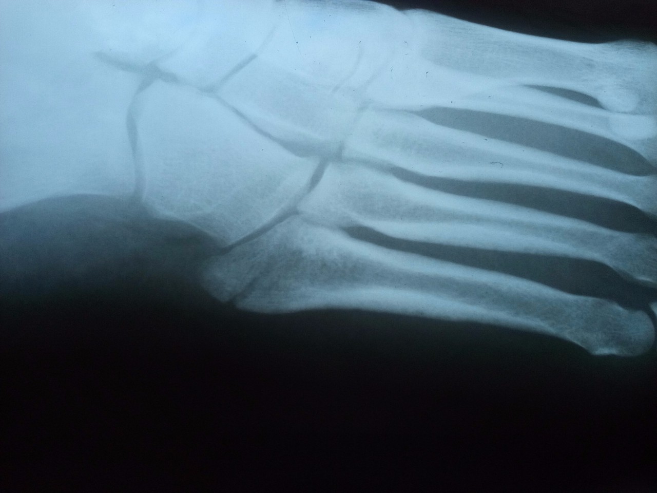 Перелом плюсневой кости стопы фото ноги