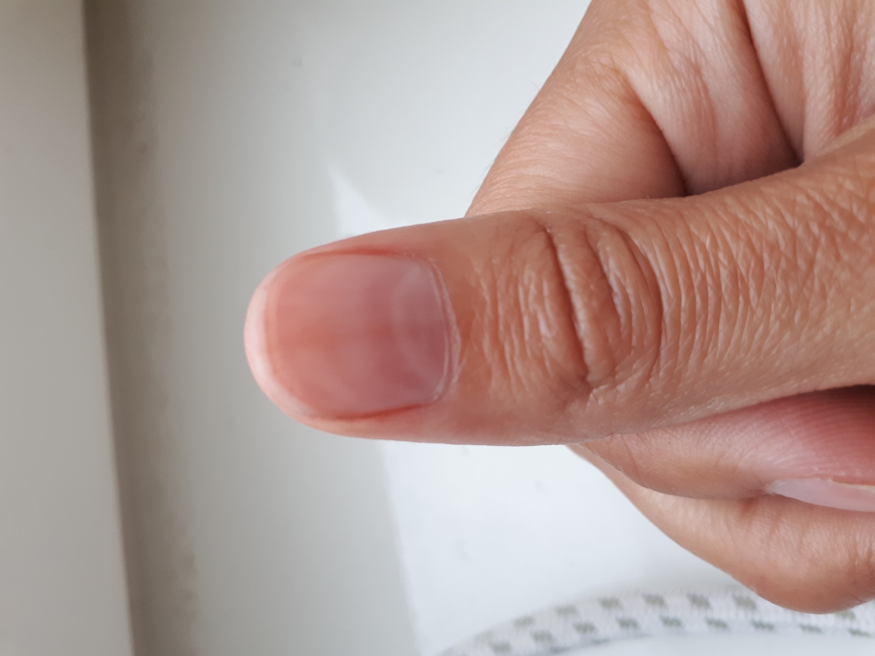 Полоски на ногтях причины вертикальные у женщин. Подногтевая меланома большого пальца руки. Полоска на ногте большого пальца. Полоска на пальце под ногтем. Продольная полоса на ногте большого пальца.