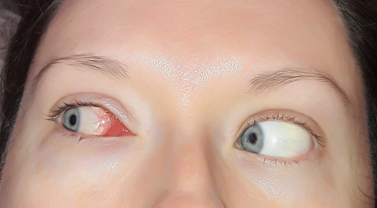 Чешутся уголки глаз — причины и лечение