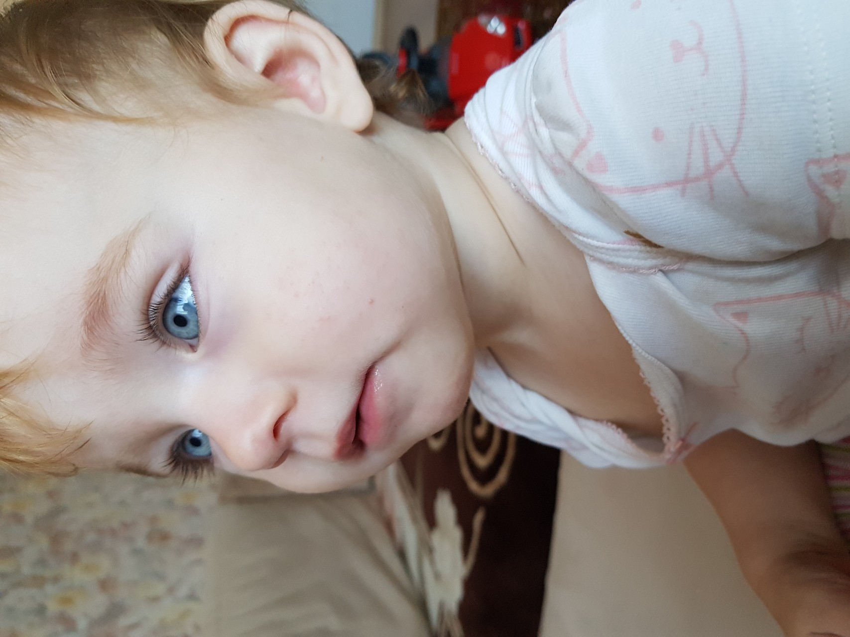 пятно на щеке у ребенка фото
