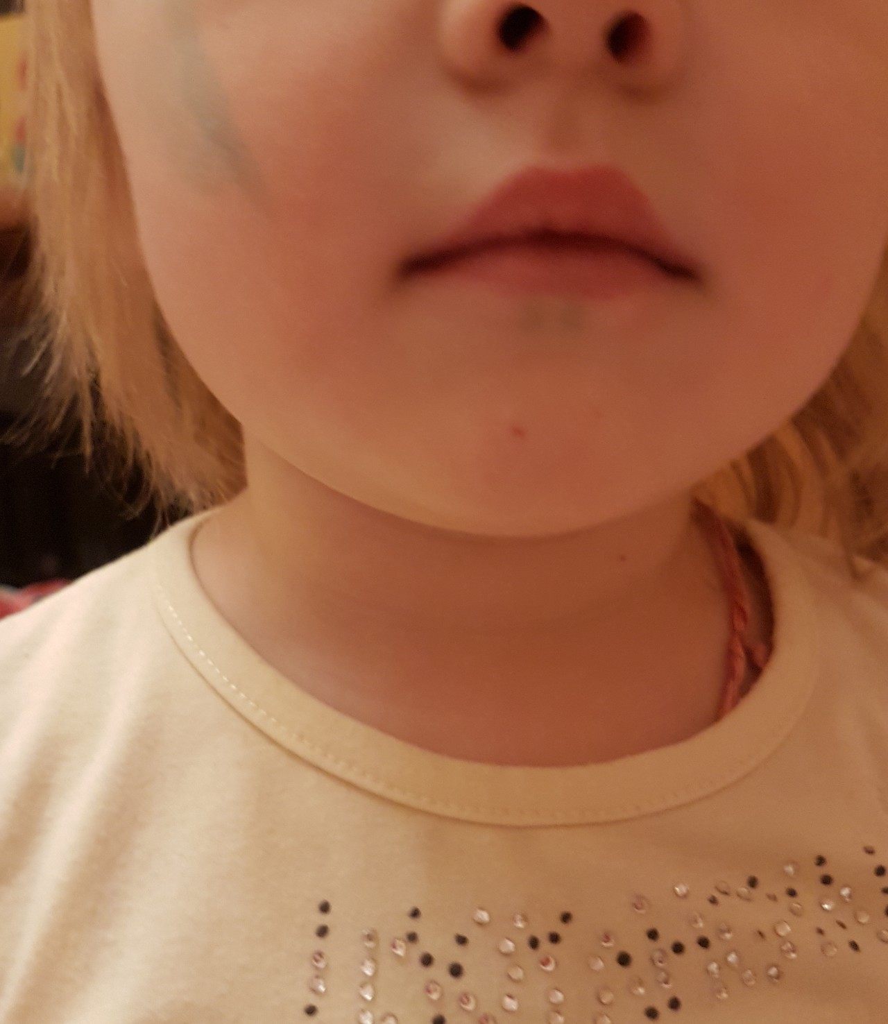Увеличенная щитовидная железа у ребенка