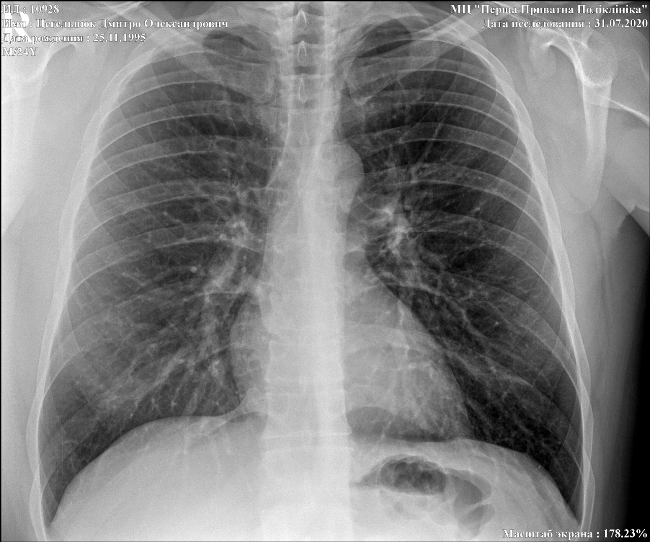 Пневмония на рентгене легких и туберкулез