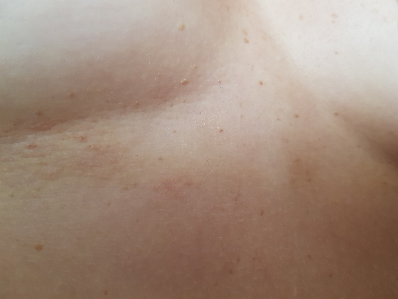 аллергия на груди у беременной фото 95