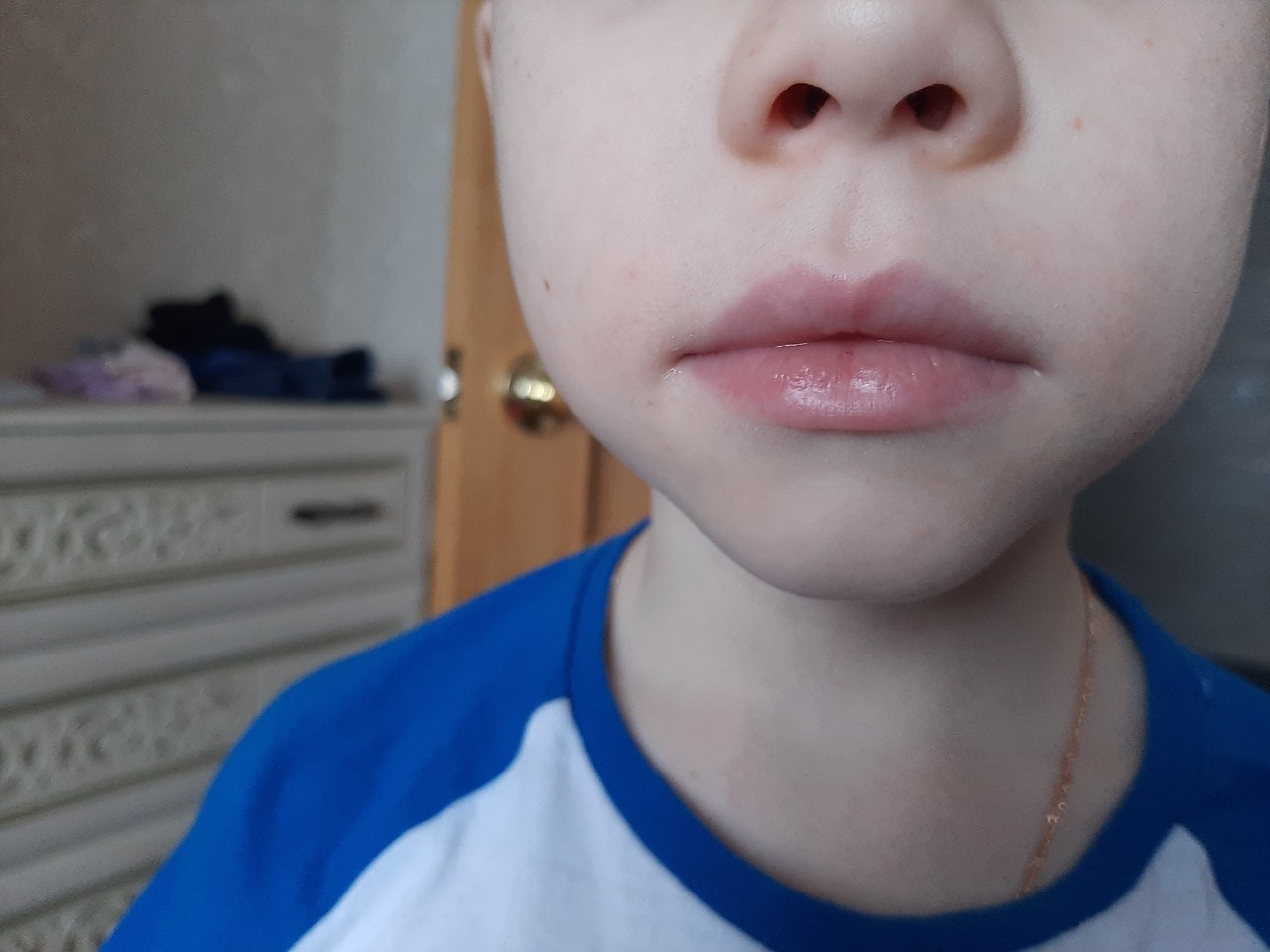 аллергия вокруг рта фото