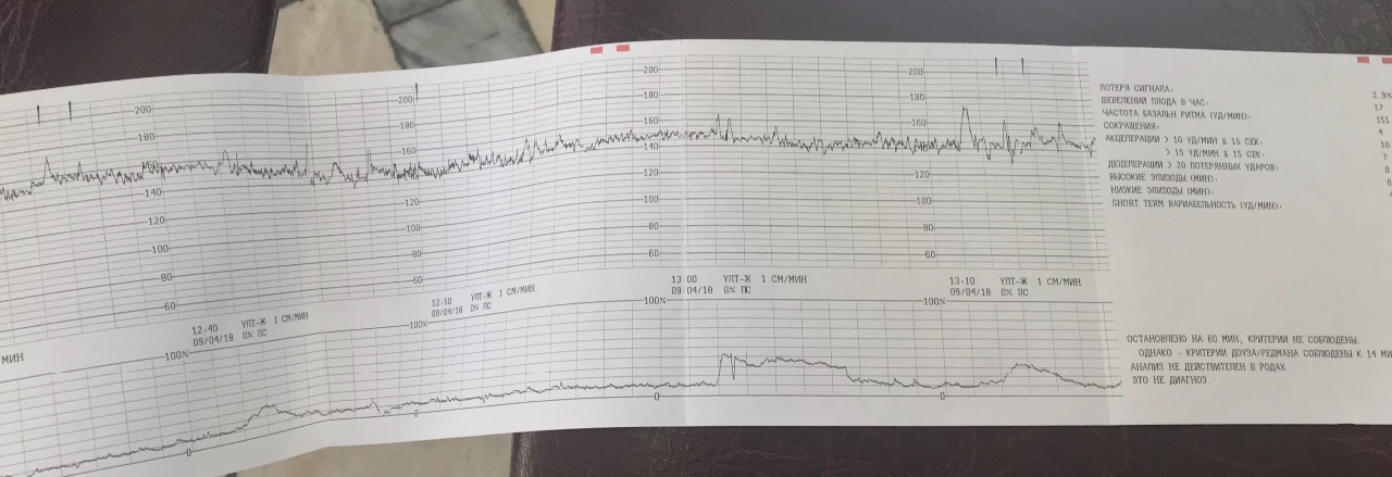 Сердцебиение плода на ктг