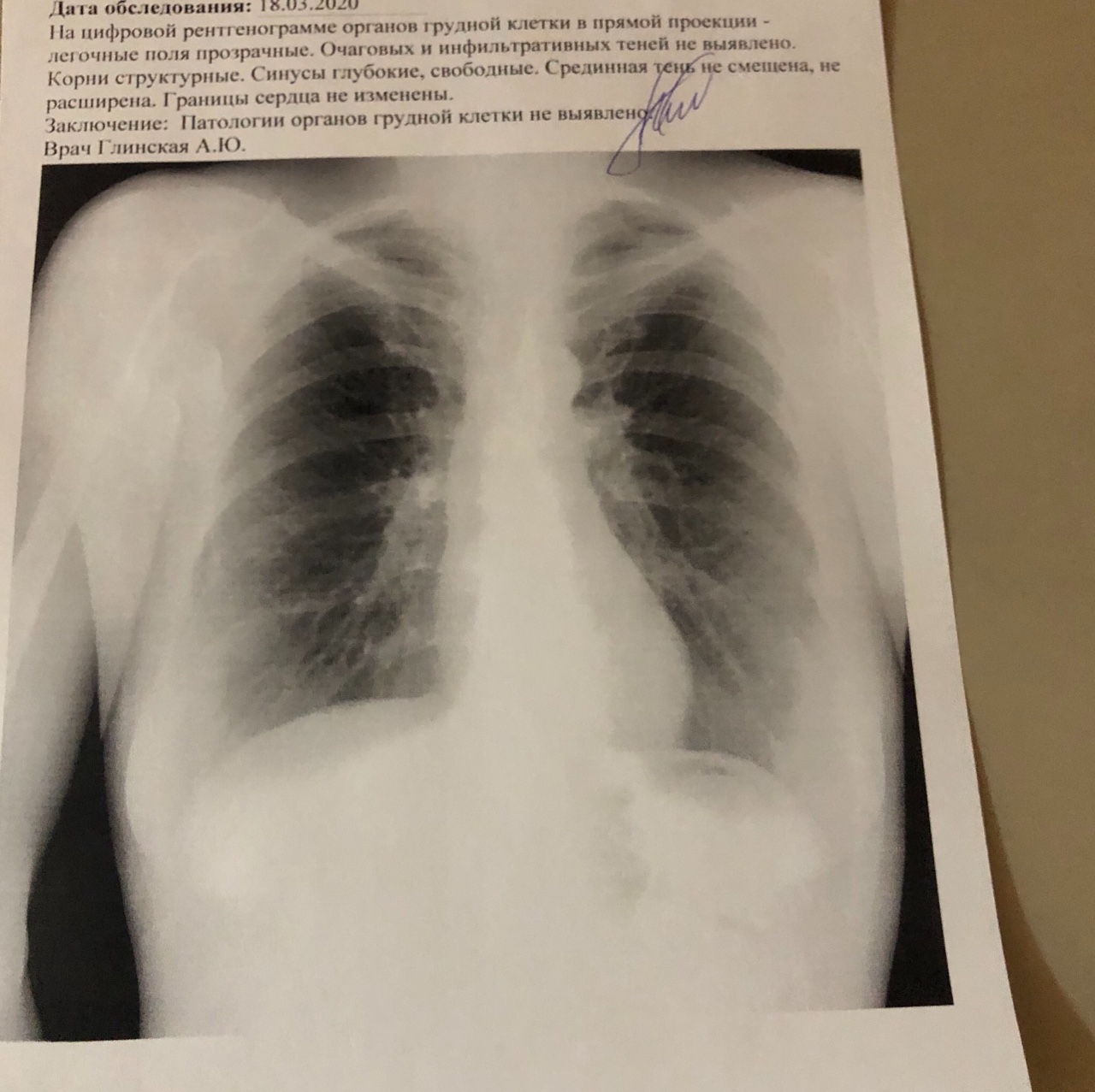 Пневмония на снимке ФЛГ легких