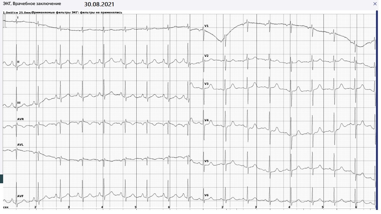 Экг рейтинг. AVR ЭКГ расшифровка. Расшифровка ЭКГ RR 0,8. КЖЗЧ ЭКГ. ЭКГ для чайников.