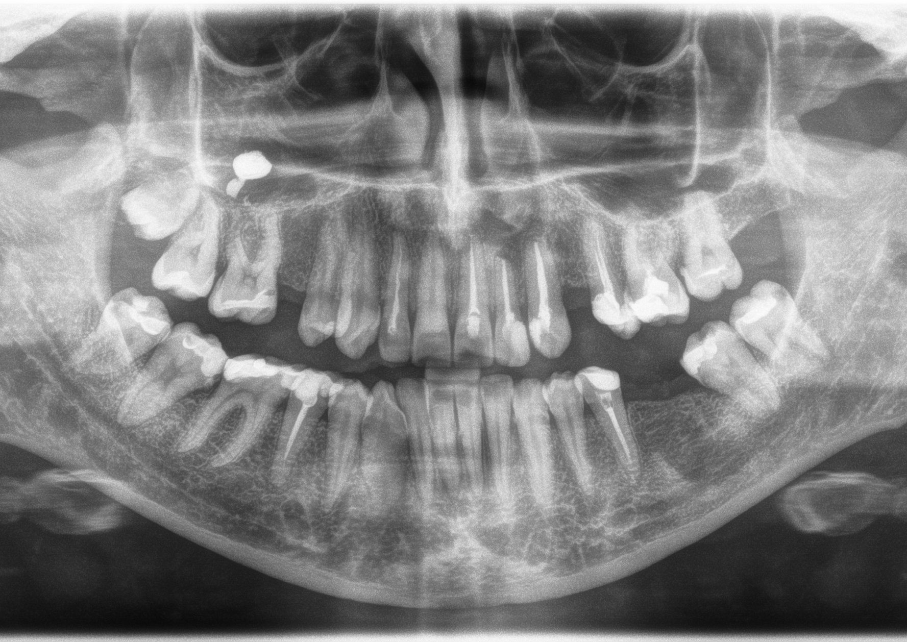 7 Зуб нижней челюсти