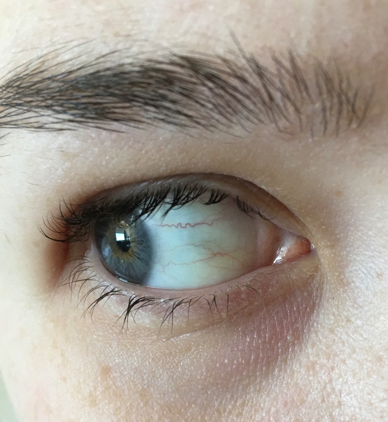 Почему глаза желтоватого. Меланоз склеры гиперметропия. Желтизна на белках глаз.
