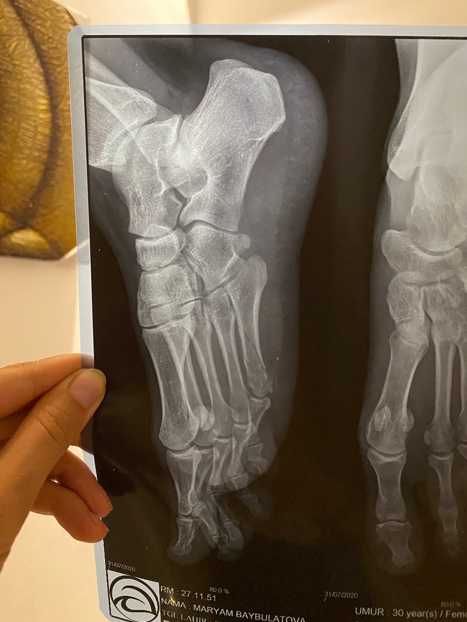 Трещина кости на ноге. Рентген 5 плюсневой кости. Рентген перелома 5 плюсневой кости. Перелом плюсневой кости стопы рентген. Рентген сросшейся плюсневой кости.