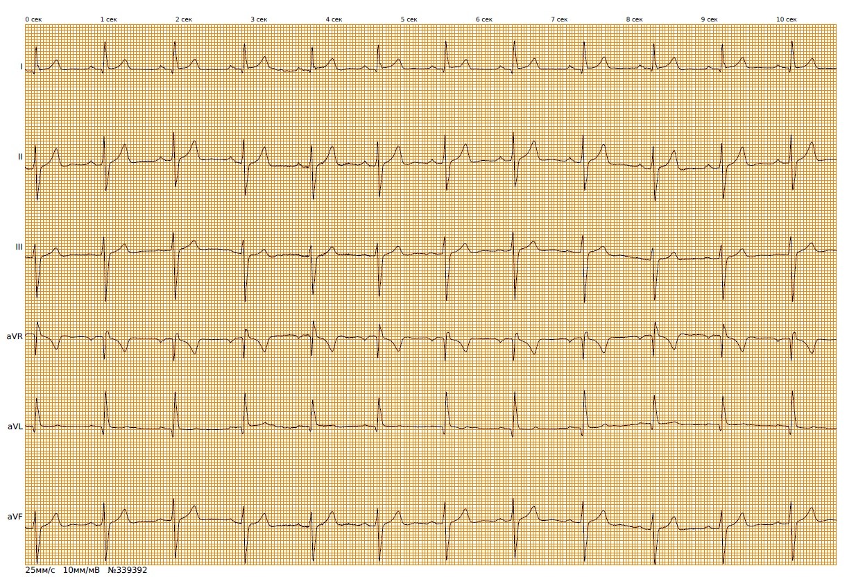 Экг в московский. ЭКГ. Нормальная кардиограмма. ЭКГ норма. Расшифровка кардиограммы.