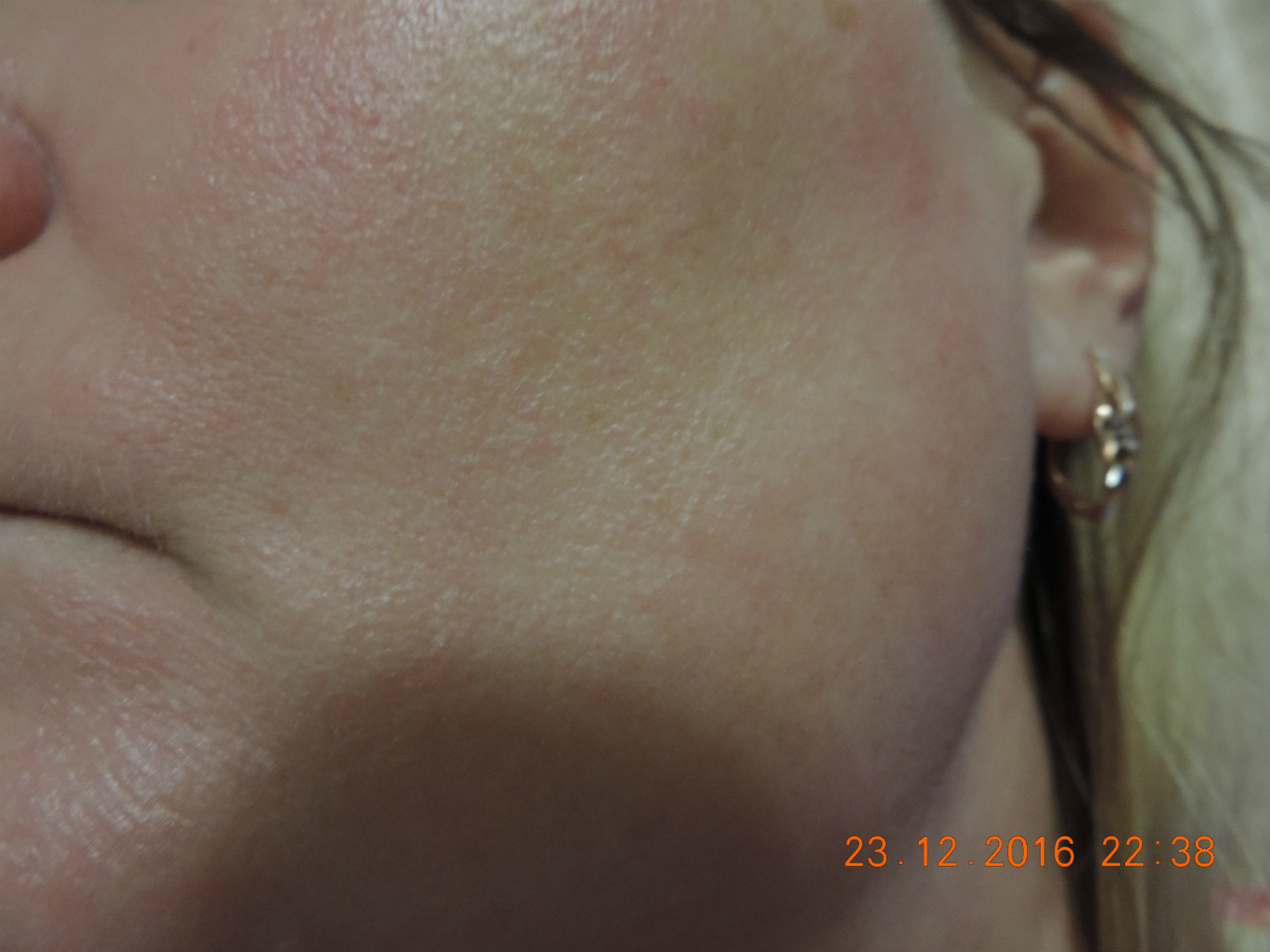 Аллергия у мастера маникюра. Аллергия на ногтевую пыль на лице. Аллергия на маникюр на лице.