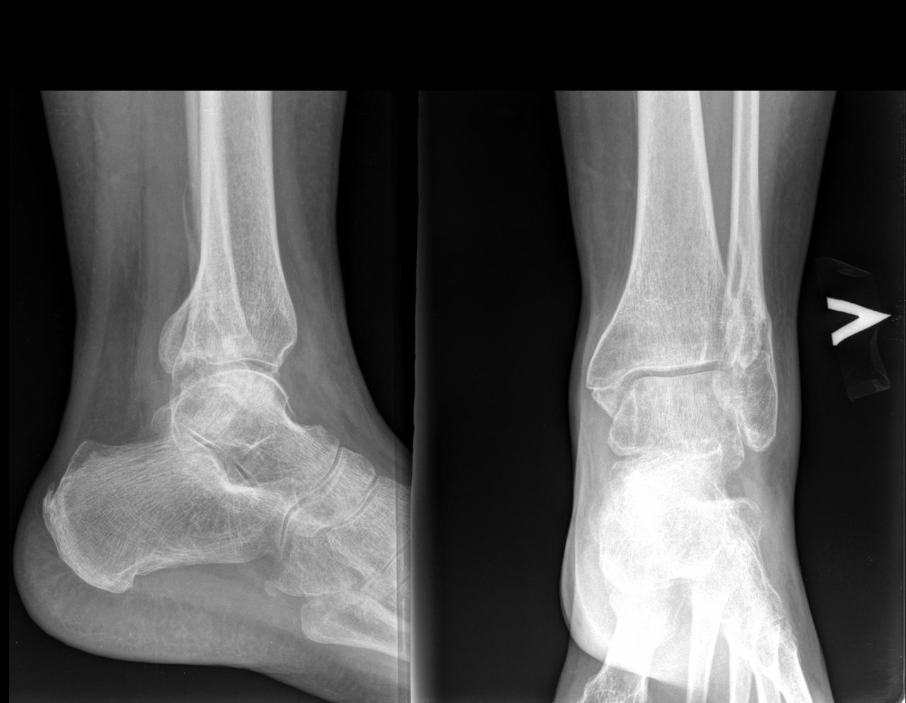 Разрыв связок голеностопного сустава фото рентген