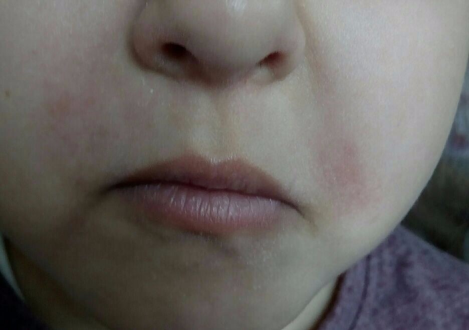 Треугольник вокруг рта. Периоральный дерматит. Периоральный дерматит у новорожденных. Периоральный дерматит околоротовой. Розацеаподобный периоральный дерматит.