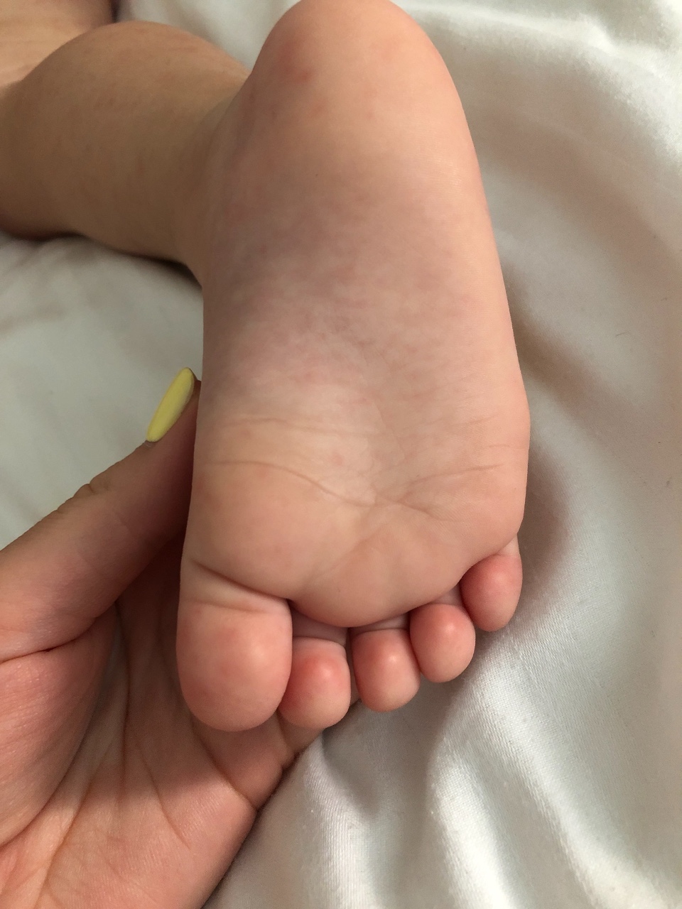 Сыпь на ступнях ног у ребенка