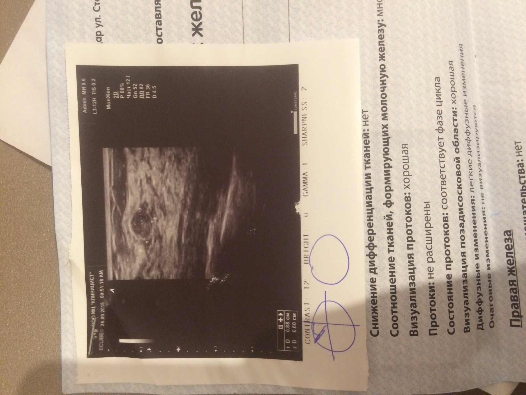 фиброаденома в груди при беременности фото 28