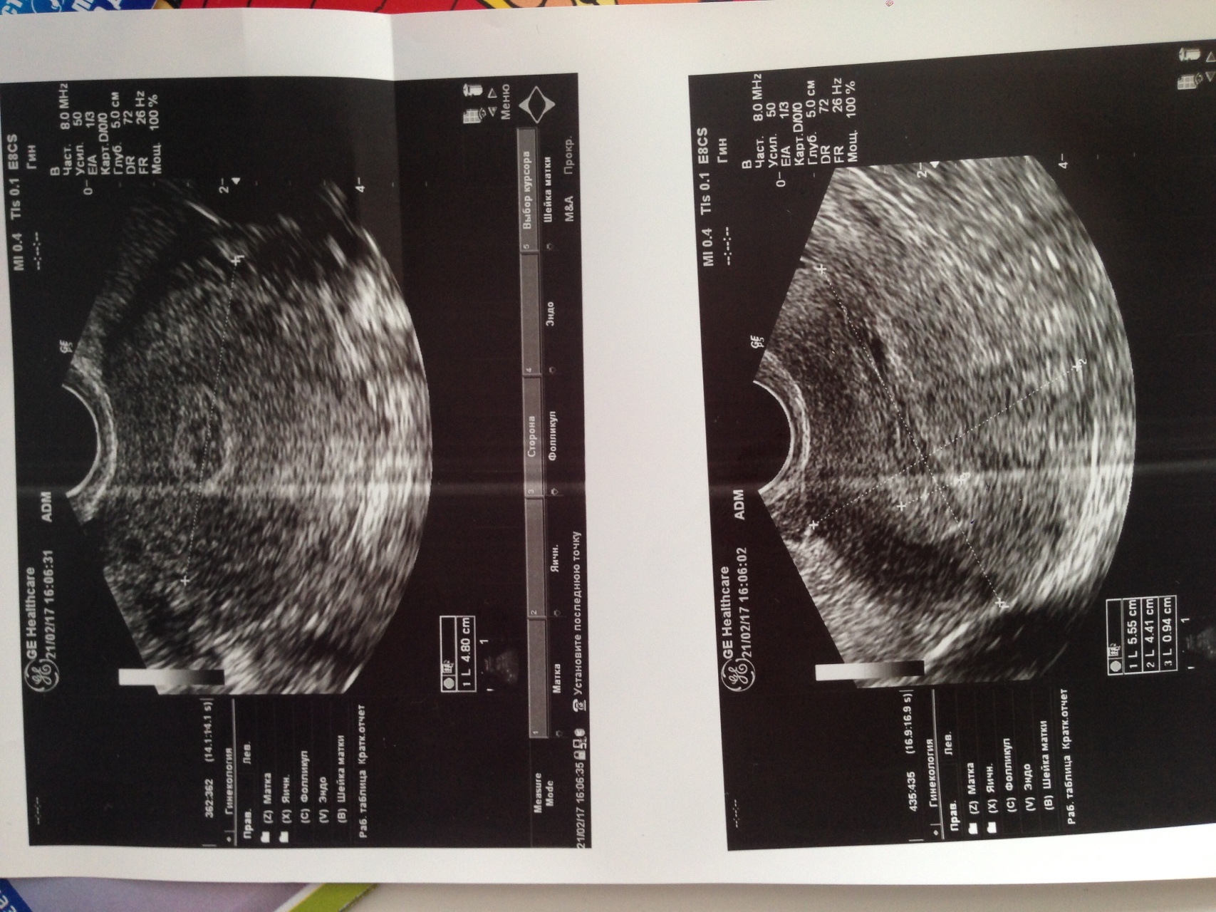 Полип после медикаментозного прерывания. Снимки УЗИ. Снимок УЗИ на раннем сроке. УЗИ беременности на ранних сроках.