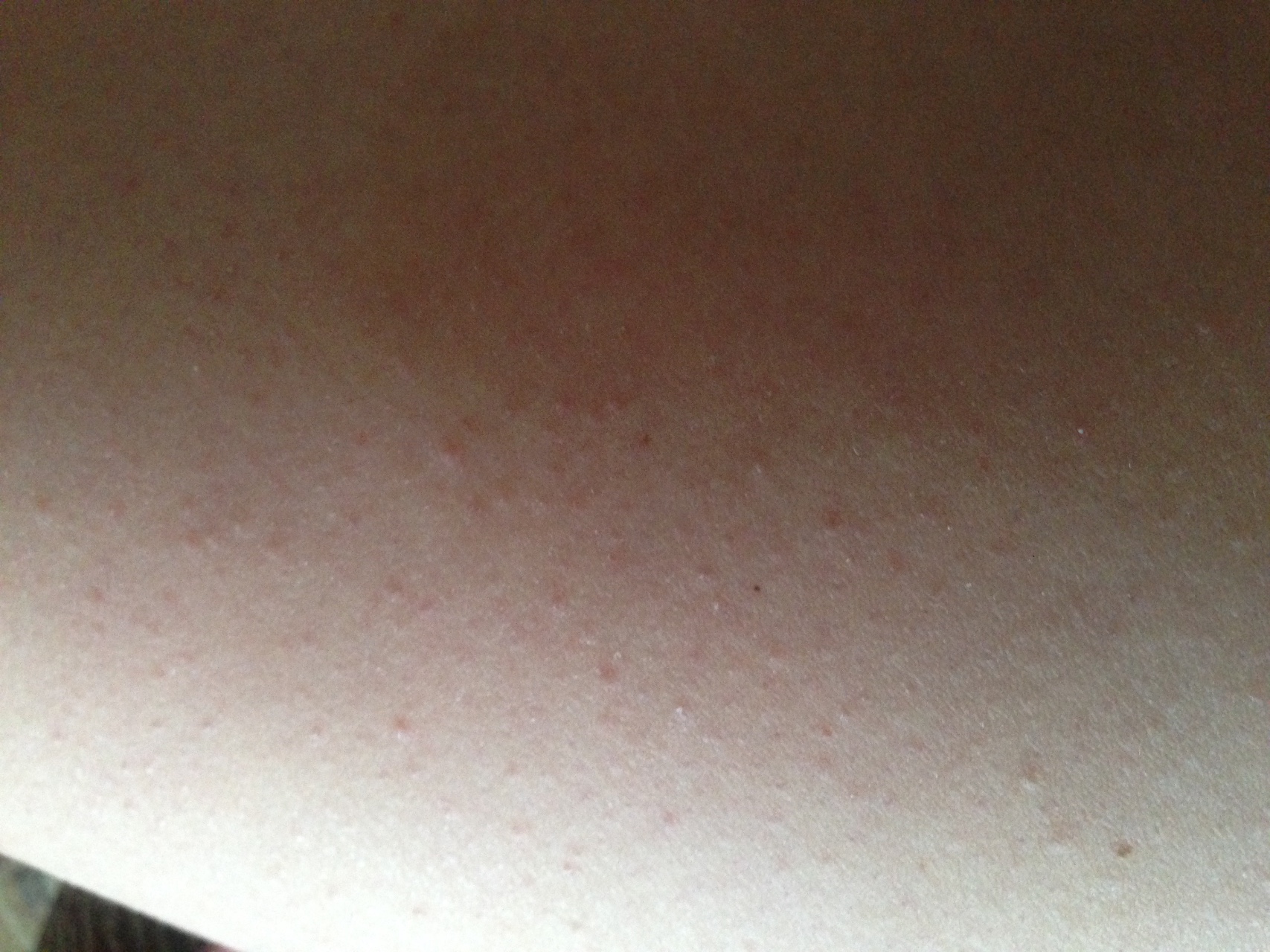 мелкая сыпь на груди у женщин фото 81