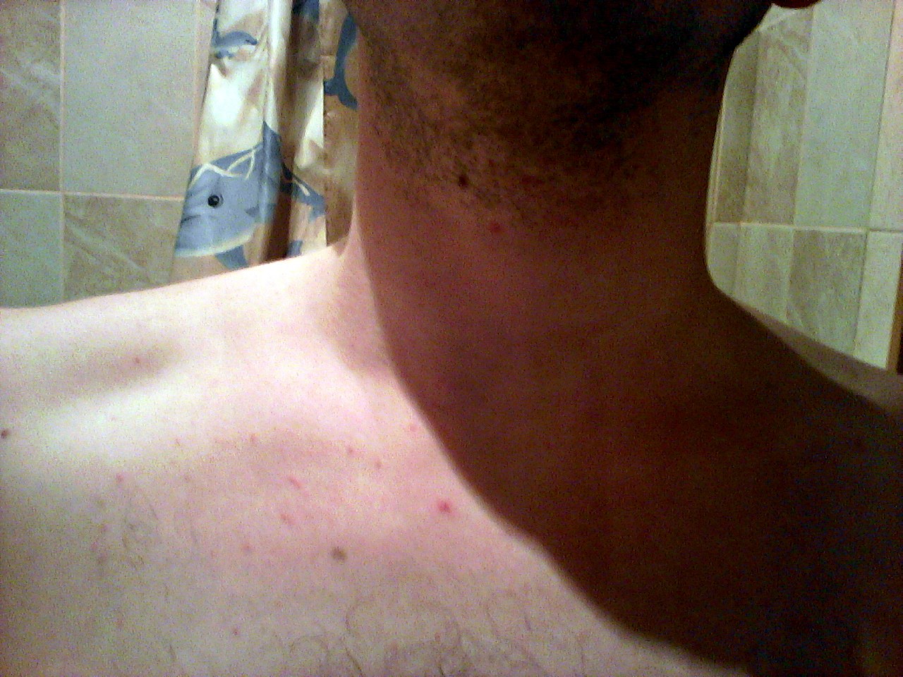 сыпь на плече до груди у мужчин фото 96