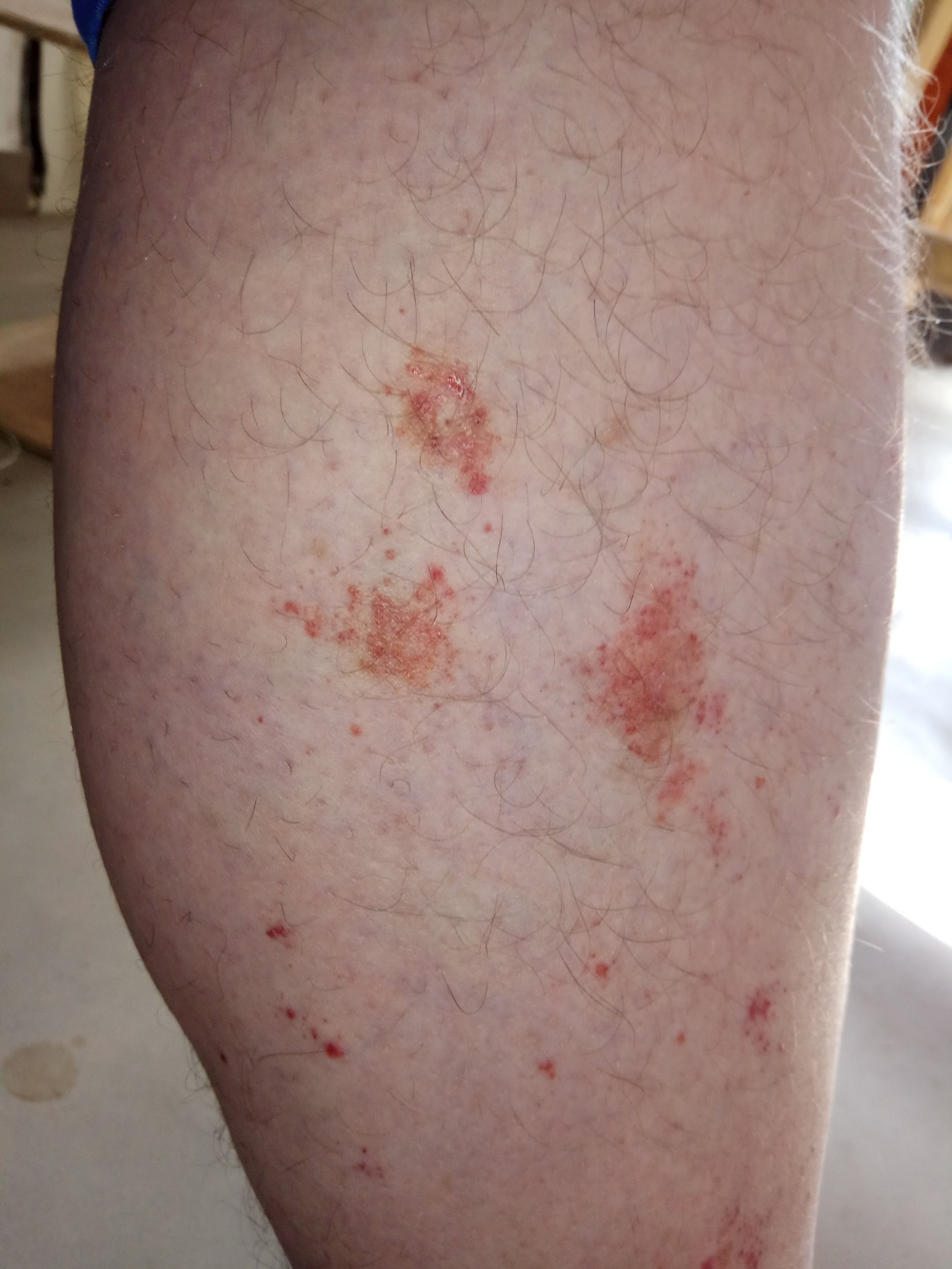 Красные пятна на ногах фото и диагноз
