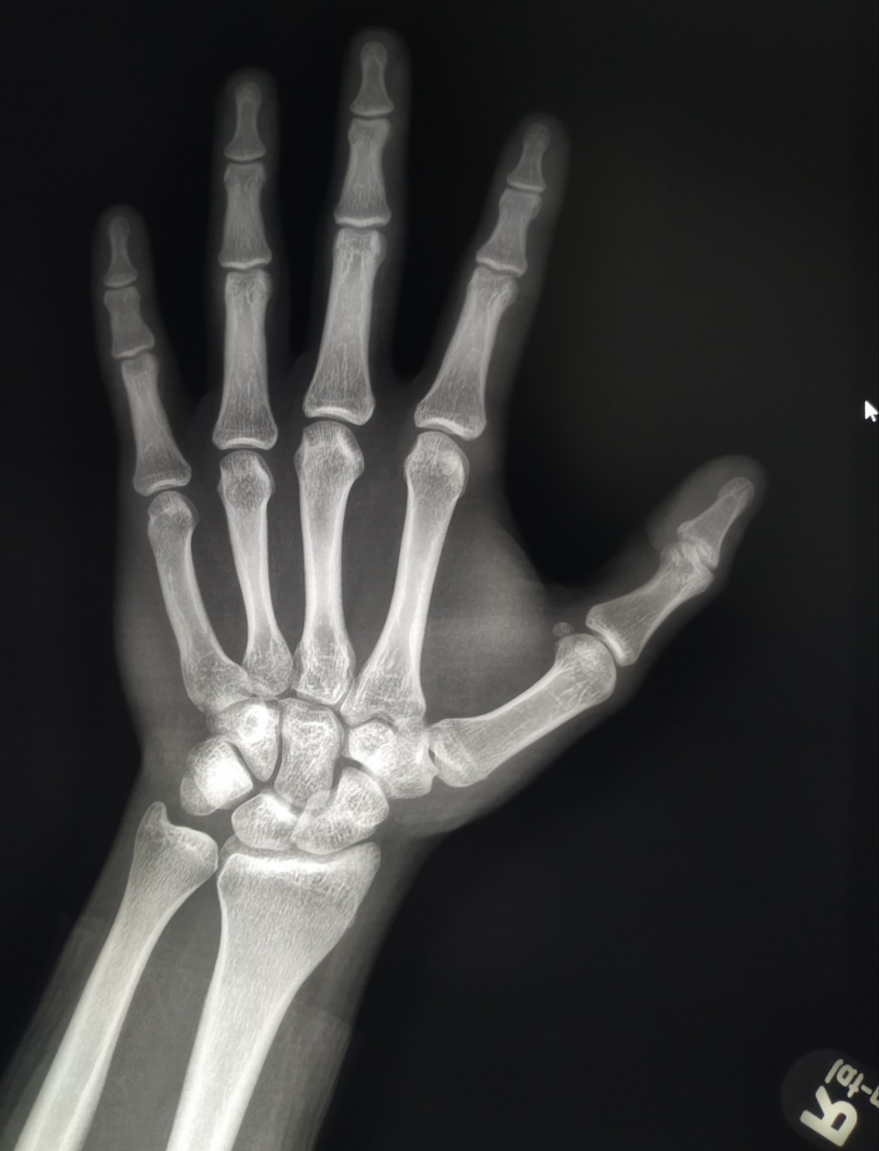 Незакрытые зоны роста костей рентген