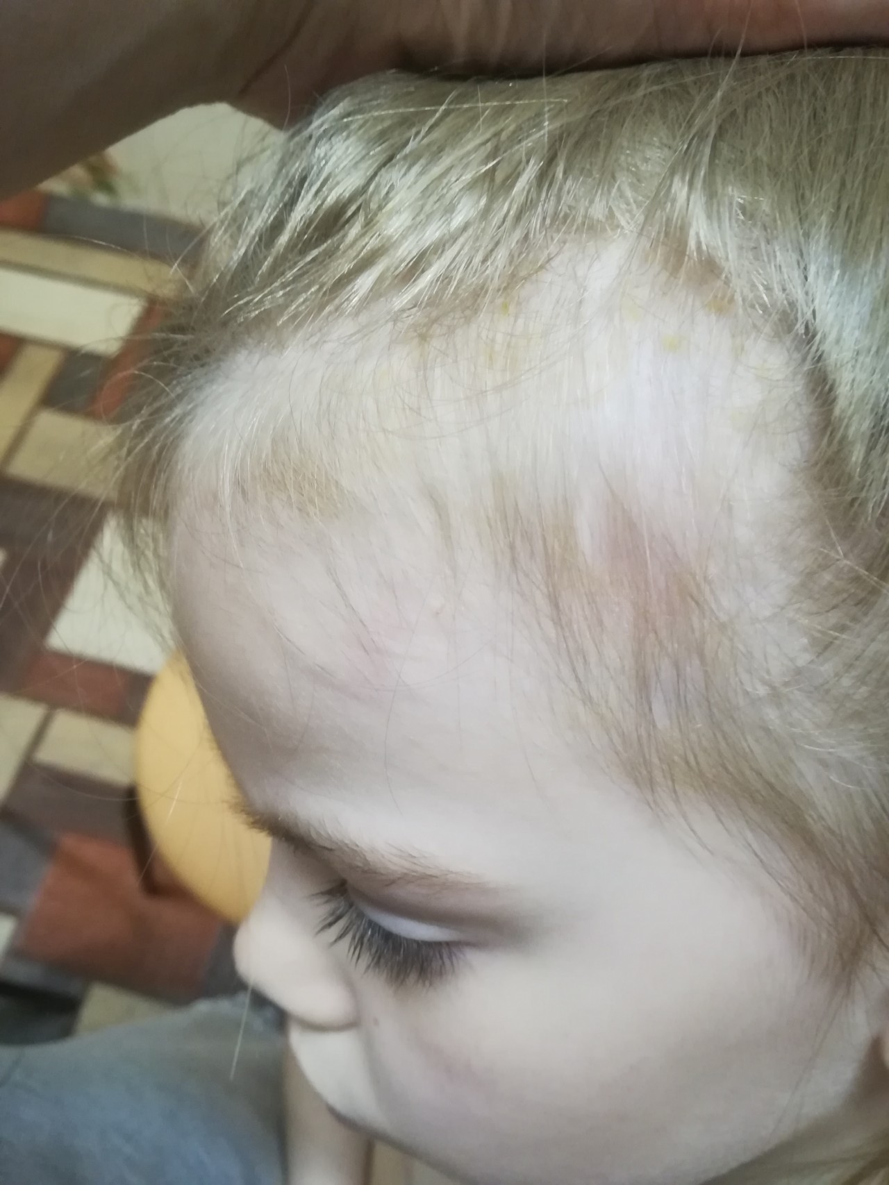 Красные пятна на голове в волосах у ребенка
