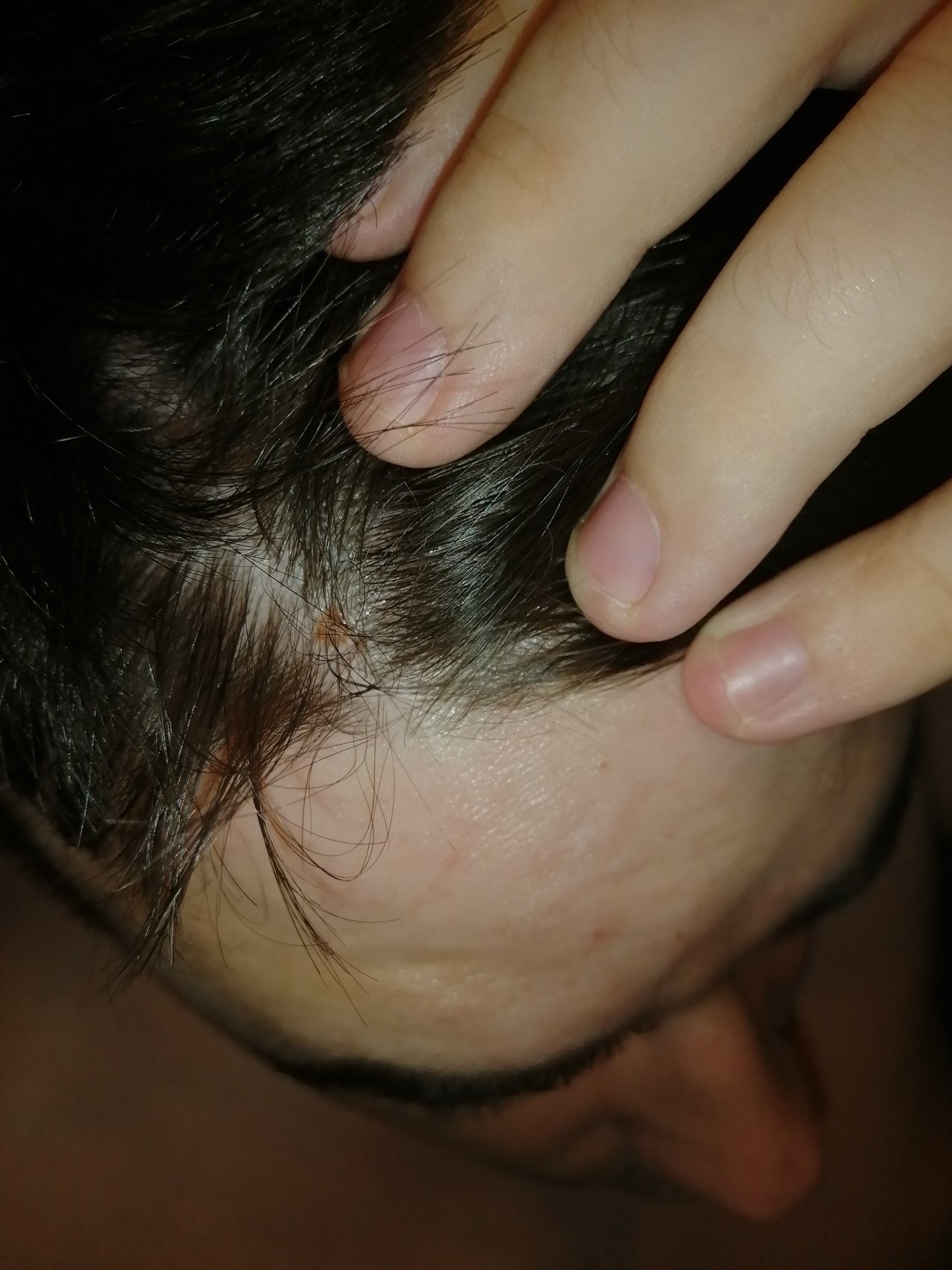 Шишки на волосистой части головы