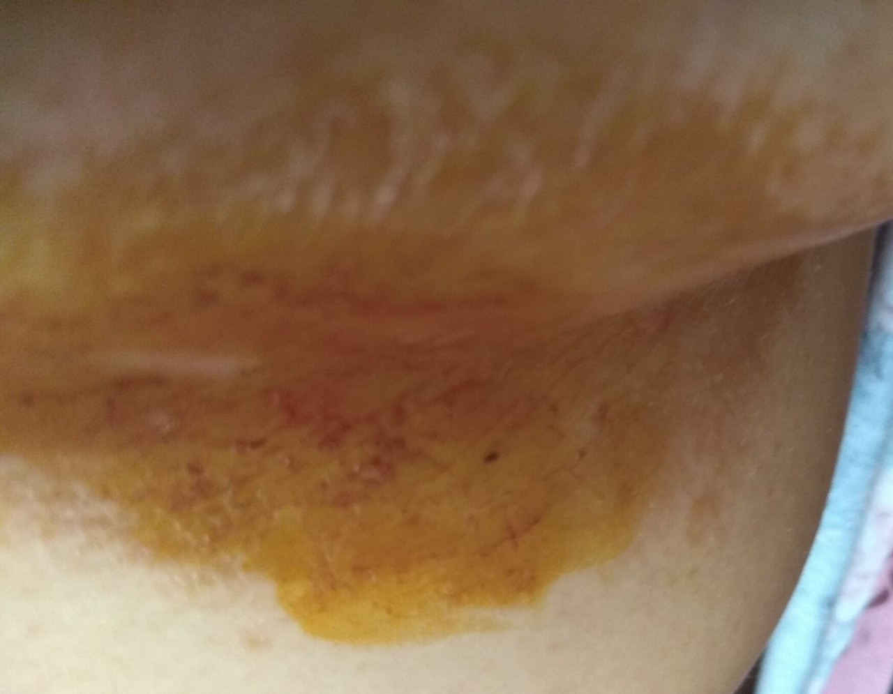 коричневые пятна на груди во время беременности фото 21