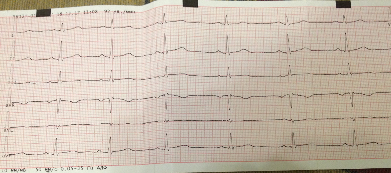 Нарушение реполяризации на экг у взрослых