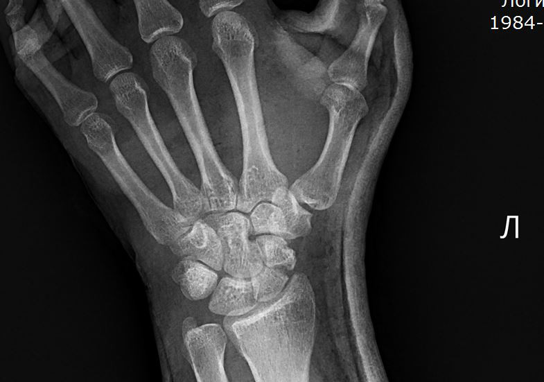 Трещина в кисти. Перелом ладьевидной кости кисти руки. Ладьевидная кость перелом рентген. Перерос ладевидной кости рентген. Ладьевидная кость руки перелом рентгенограмма.