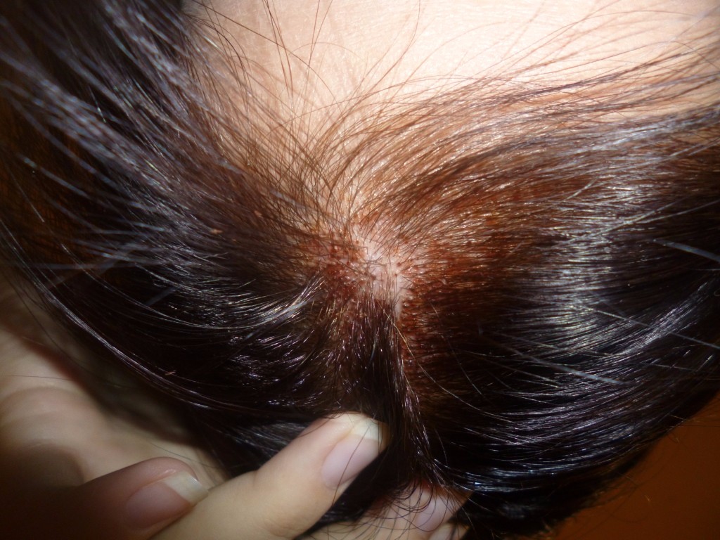 Перхоть и выпадение волос какие витамины принимать