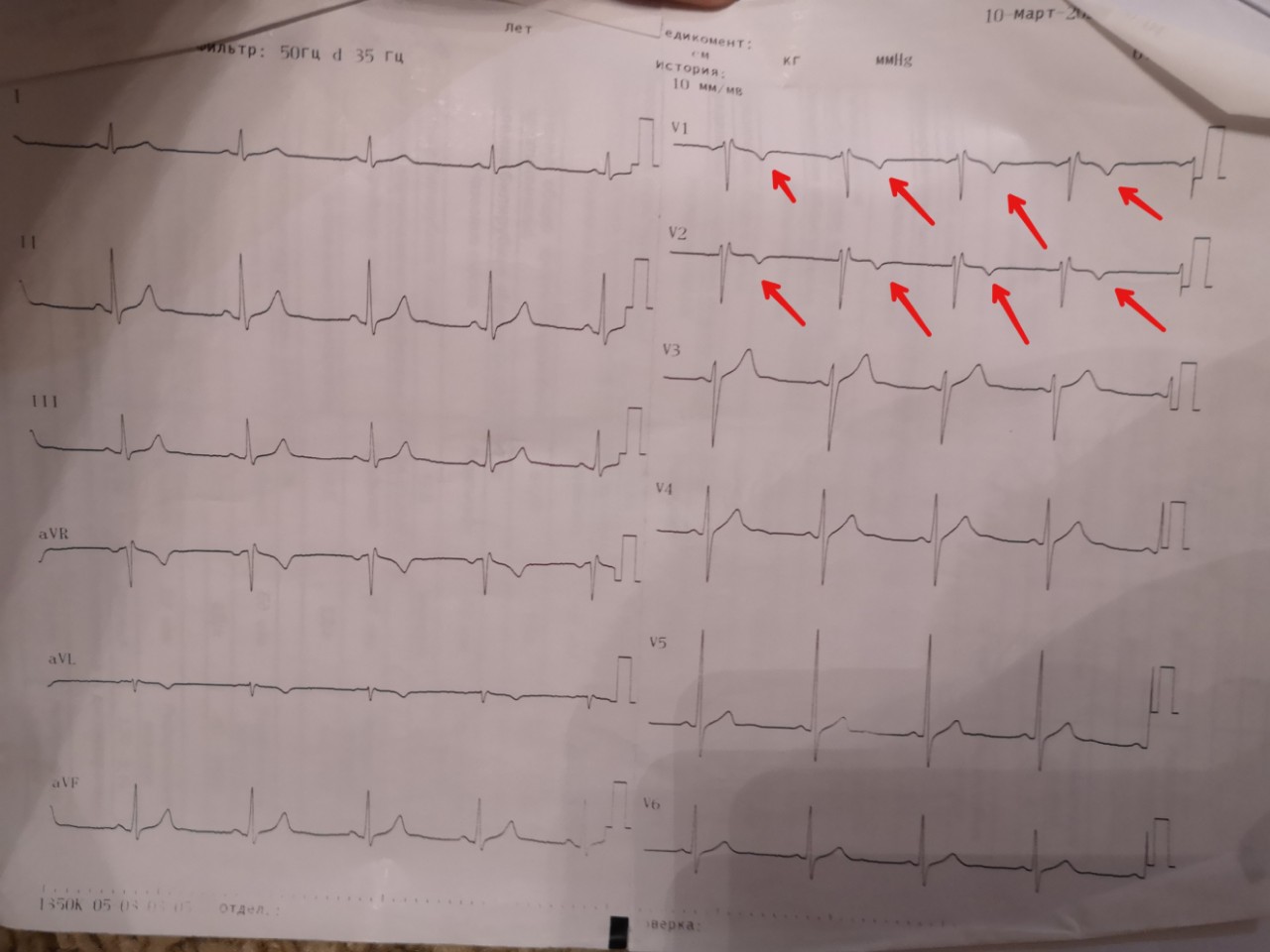 Фото кардиограммы при инфаркте. V5 отведение ЭКГ. ЭКГ ZR В v5.