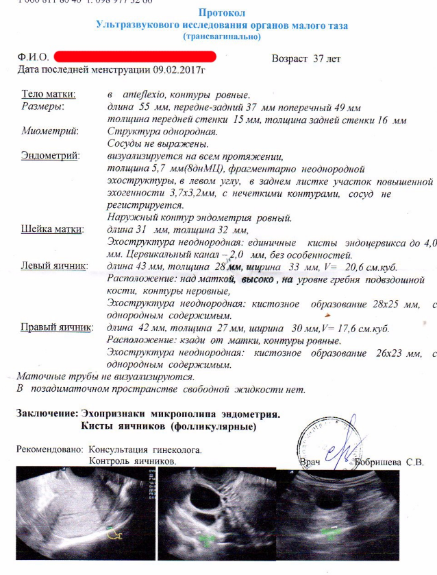 Эндометрий 8мм это норма. Норма эндометрия матки при УЗИ. УЗИ малого таза с эндометрием. Толщина эндометрия на 8 день цикла норма УЗИ.