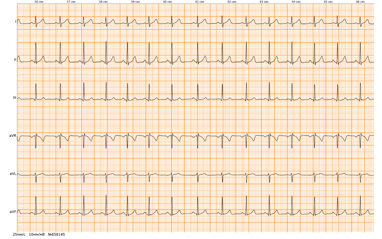 Экг водитель. Суправентрикулярный ритм на ЭКГ. Миграция водителя ритма на ЭКГ заключение.