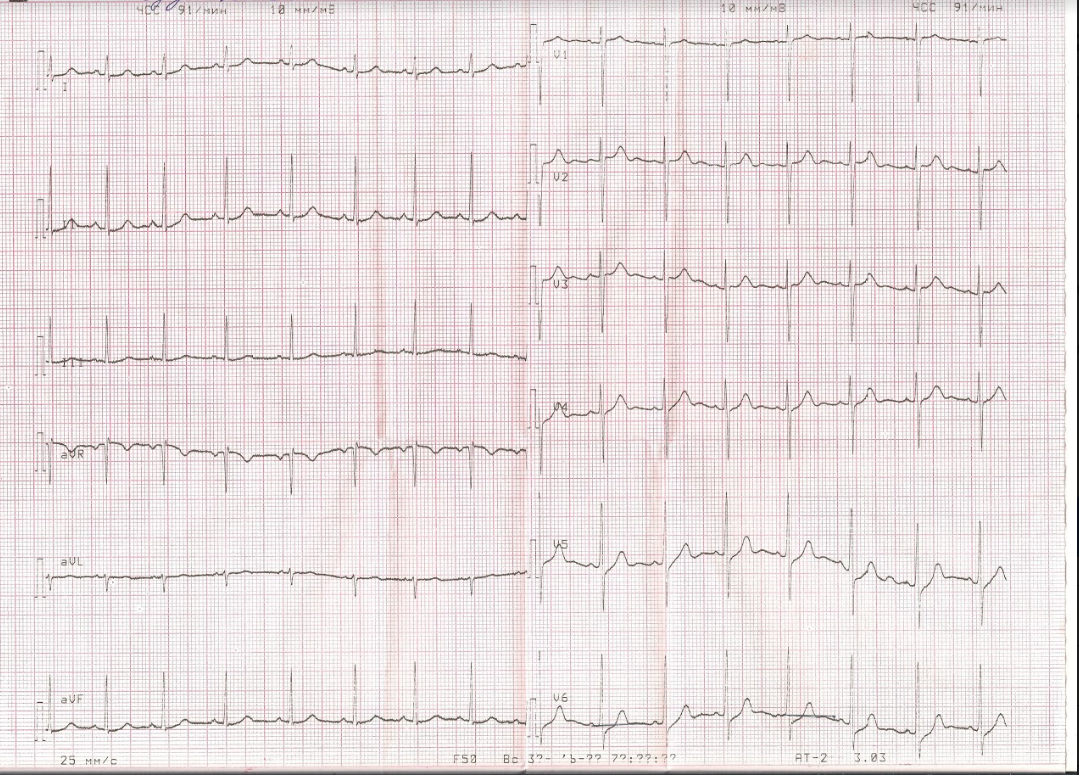 Расшифровка кардиограммы сердца по фото