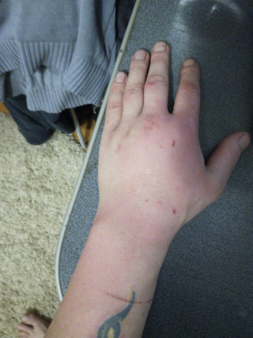 Виды аллергии на руках