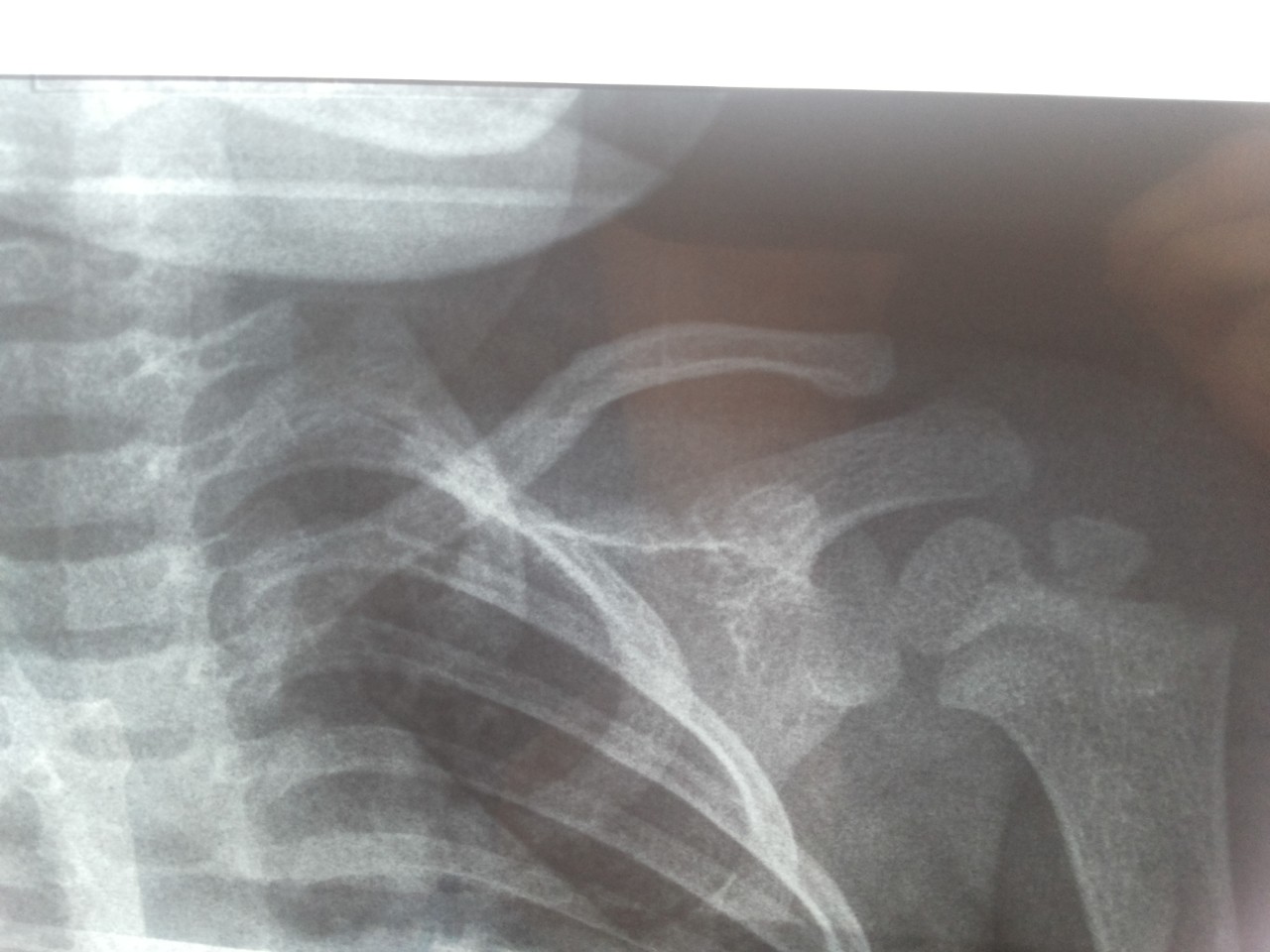 Консолидированный перелом ключицы рентген