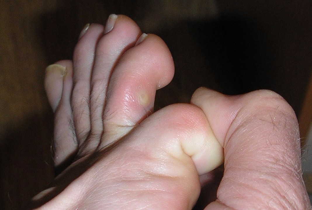 Лечение грибка между пальцев ног. Зуд и опрелость между пальцев ног.