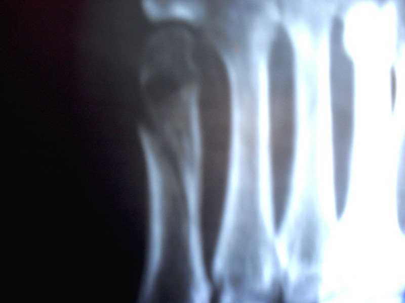 Перелом 5 плюсневой кости фото отека