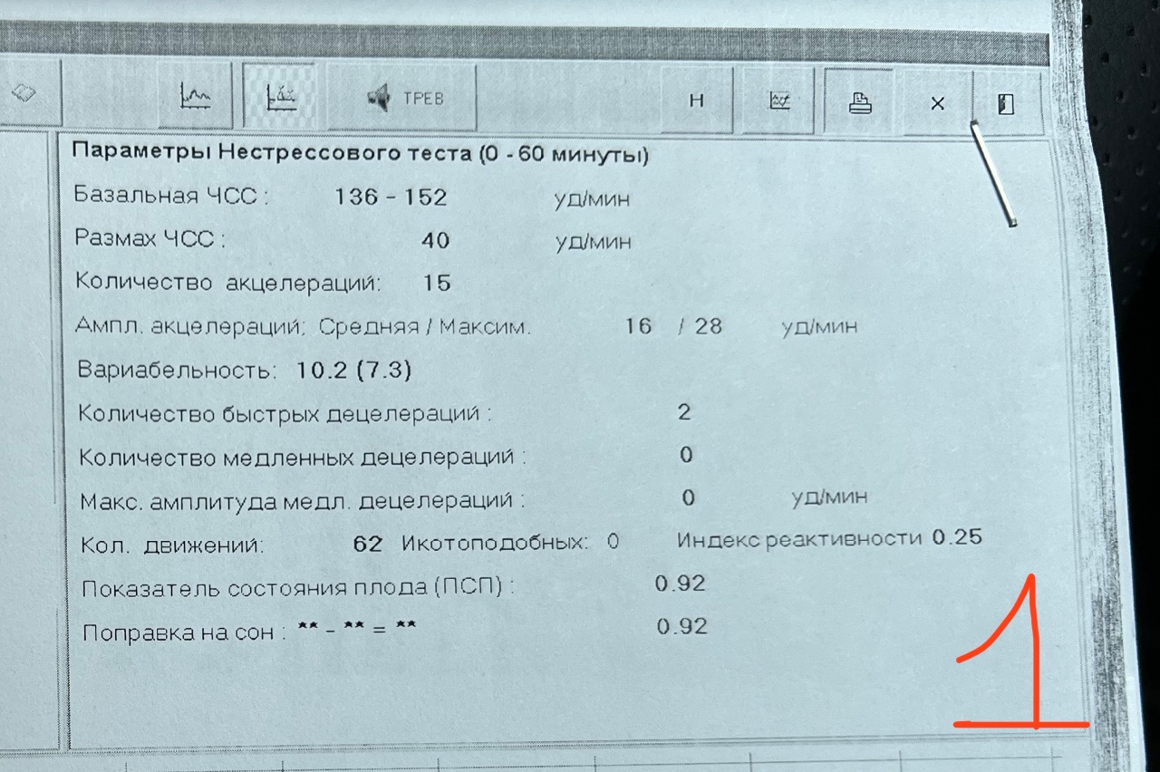 Нестрессовый тест. КТГ коэффициент технической готовности. Нестрессовый тест при КТГ. Нестрессовый тест положительный на КТГ.