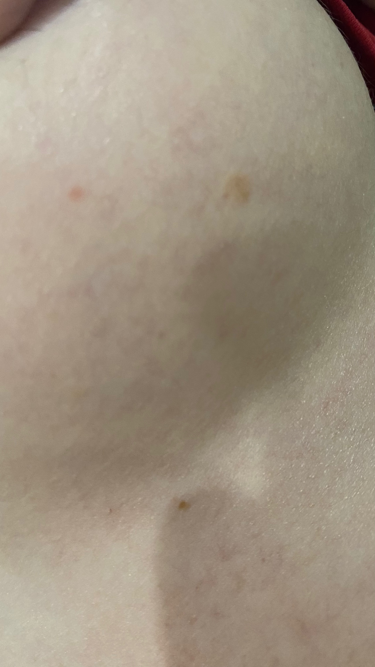 светло коричневые пятна на груди у женщин фото 5