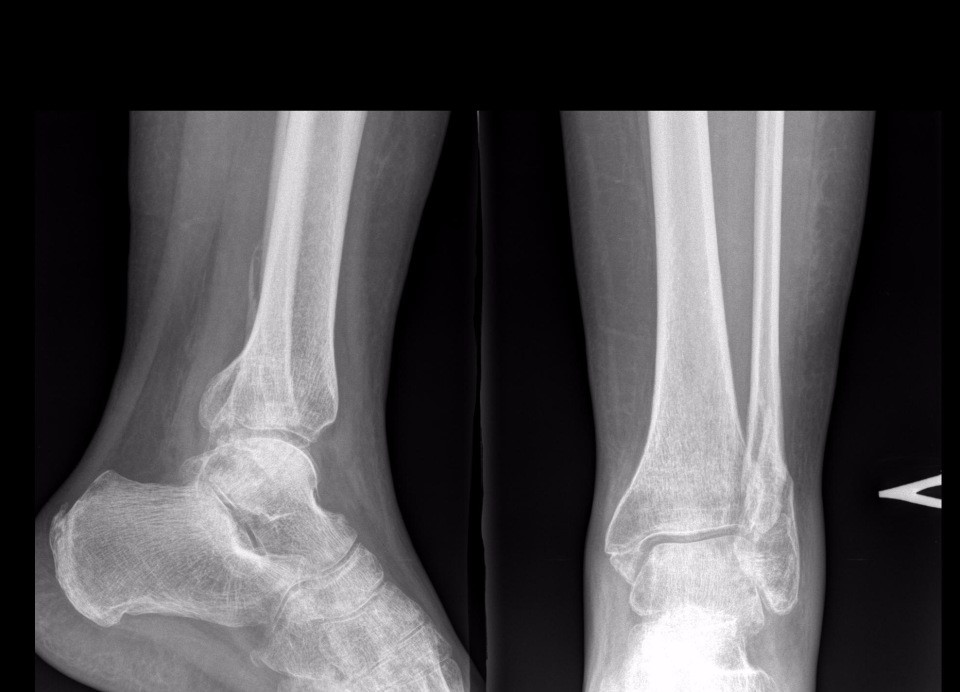 Трещина кости на ноге. Трехлодыжечный перелом лодыжки. Трехлодыжечный перелом со смещением на рентгенограмме. Трехлодыжечный перелом со смещением рентген. Перелом медиальной лодыжки большеберцовой кости.