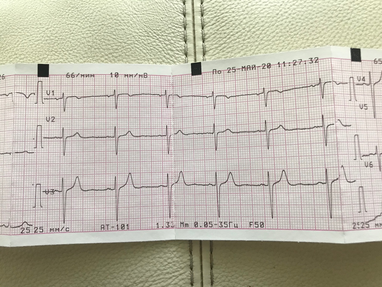 Экг 22. ЭКГ. ЭКГ кардиограмма. ЭКГ снимки. Нормальная кардиограмма сердца.