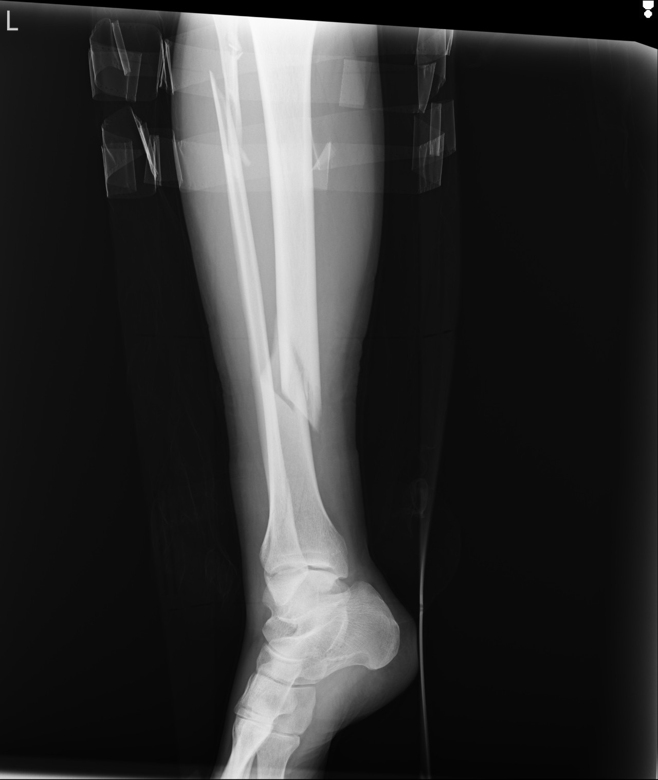 Трещина кости на ноге. Перелом берцовая кость кости.