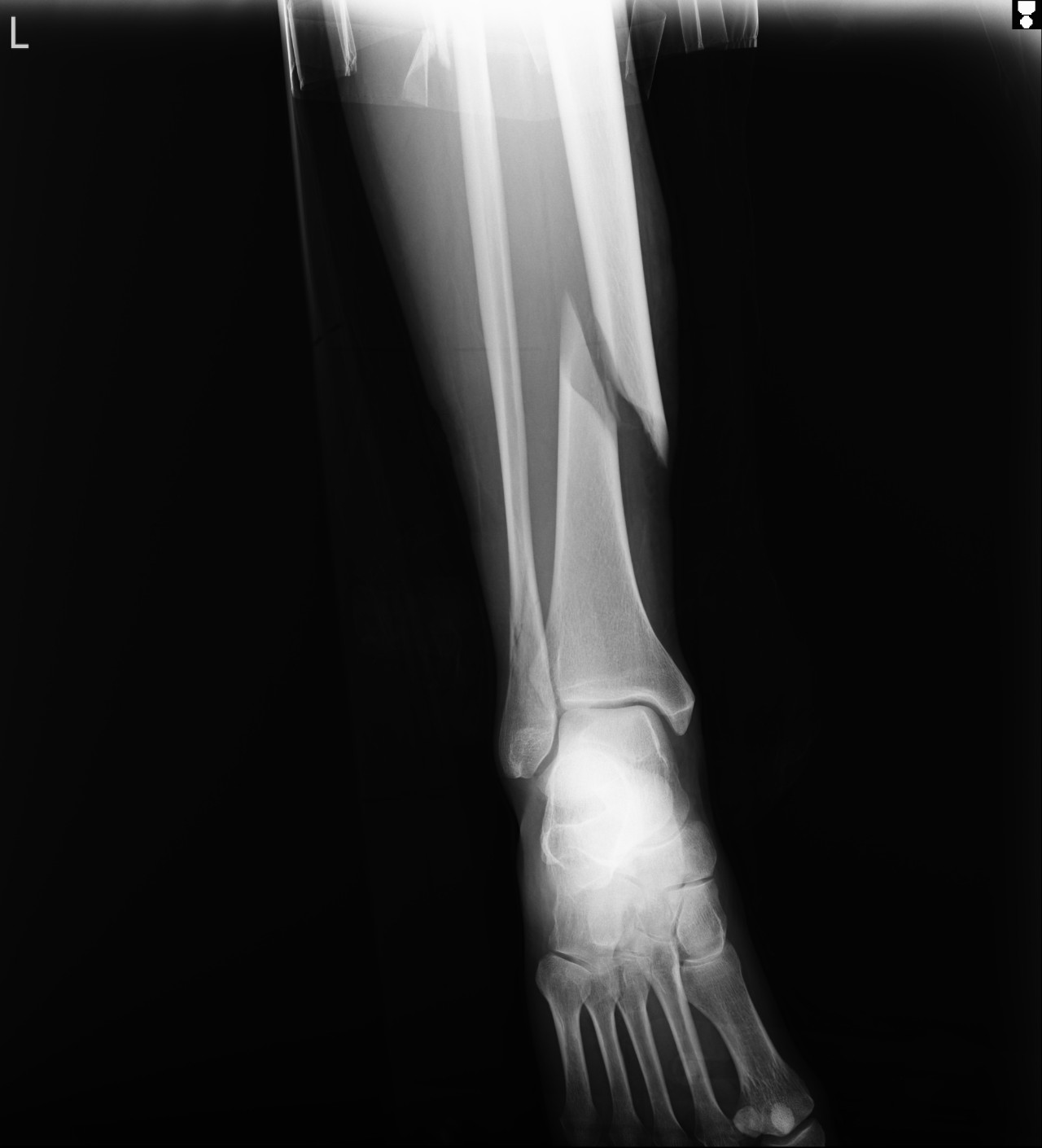 Фото рентгена ноги