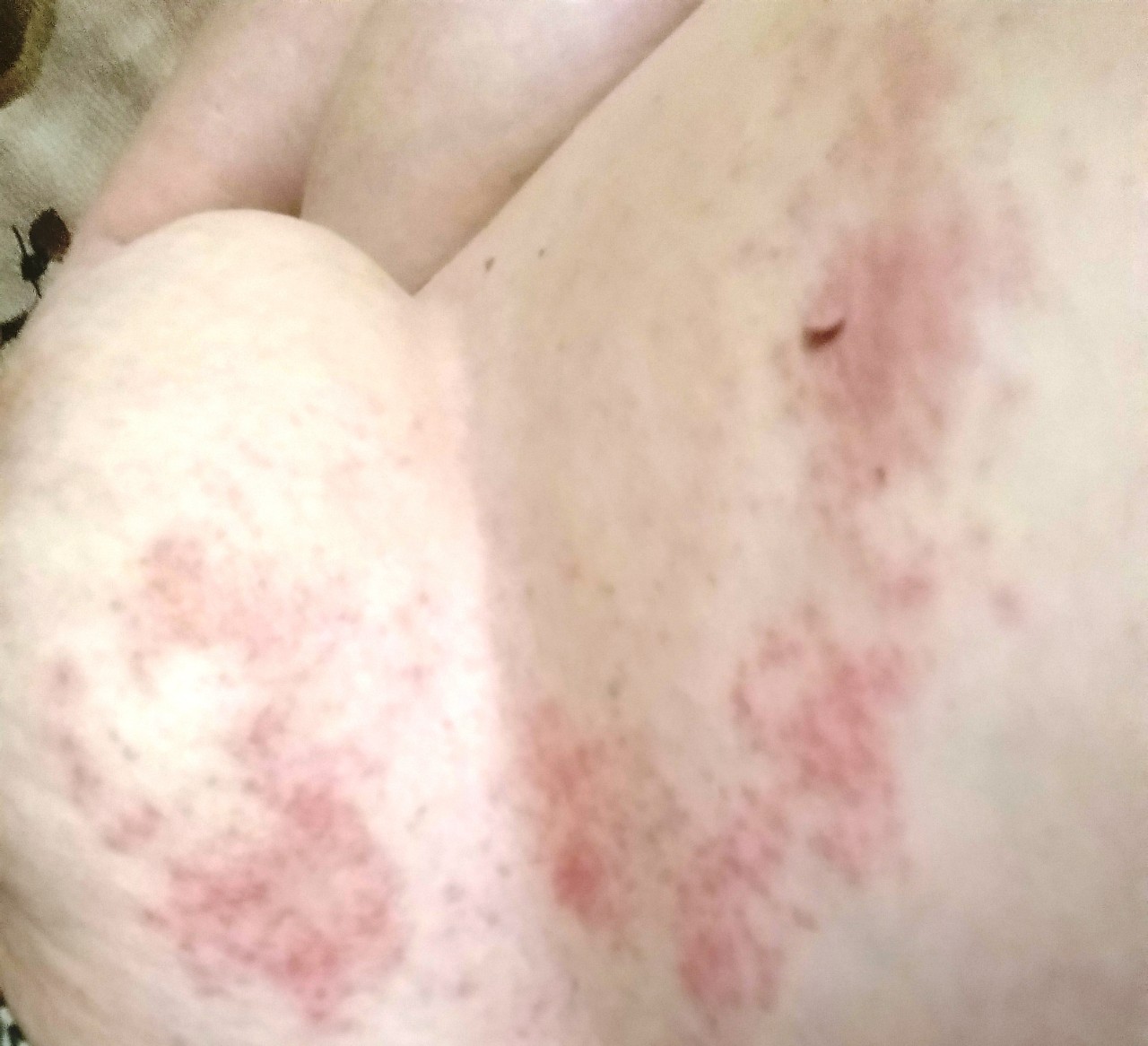 красные высыпания на груди у женщин фото 118
