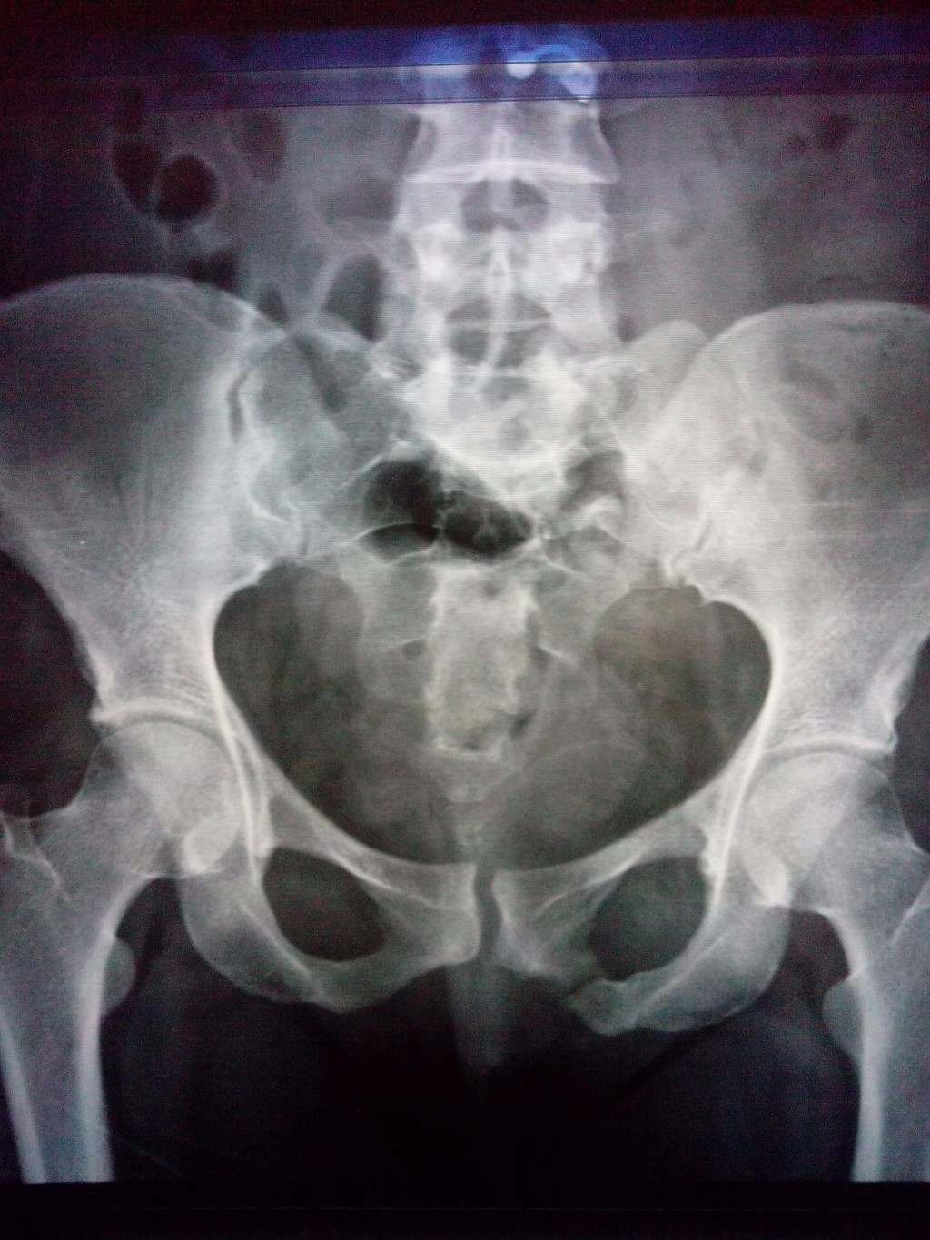 Перелом седалищной кости рентген