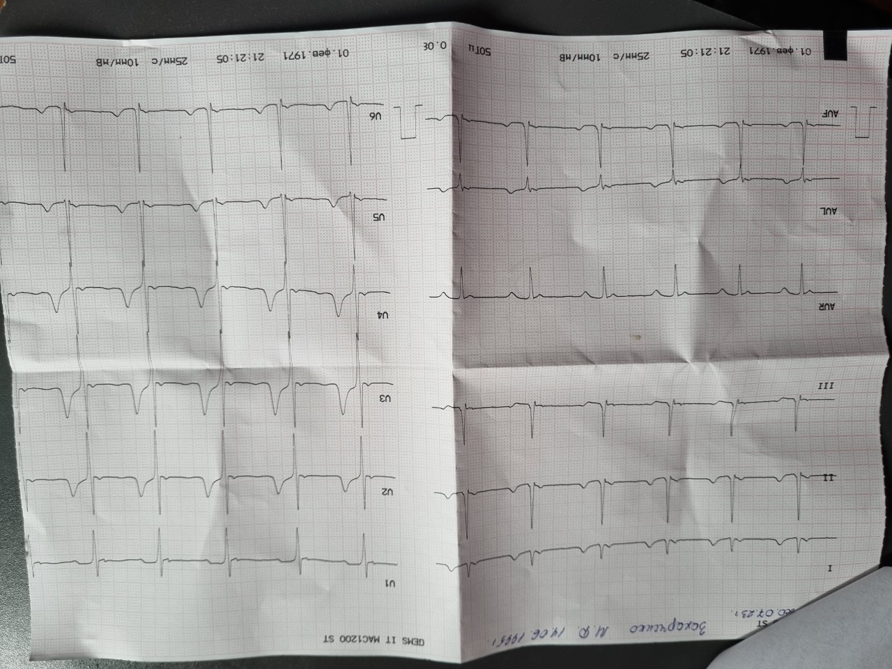 Хм экг расшифровка. ЭКГ расшифровка. Линейка для расшифровки ЭКГ. ЭКГ фото с расшифровкой. Постановка ЭКГ.