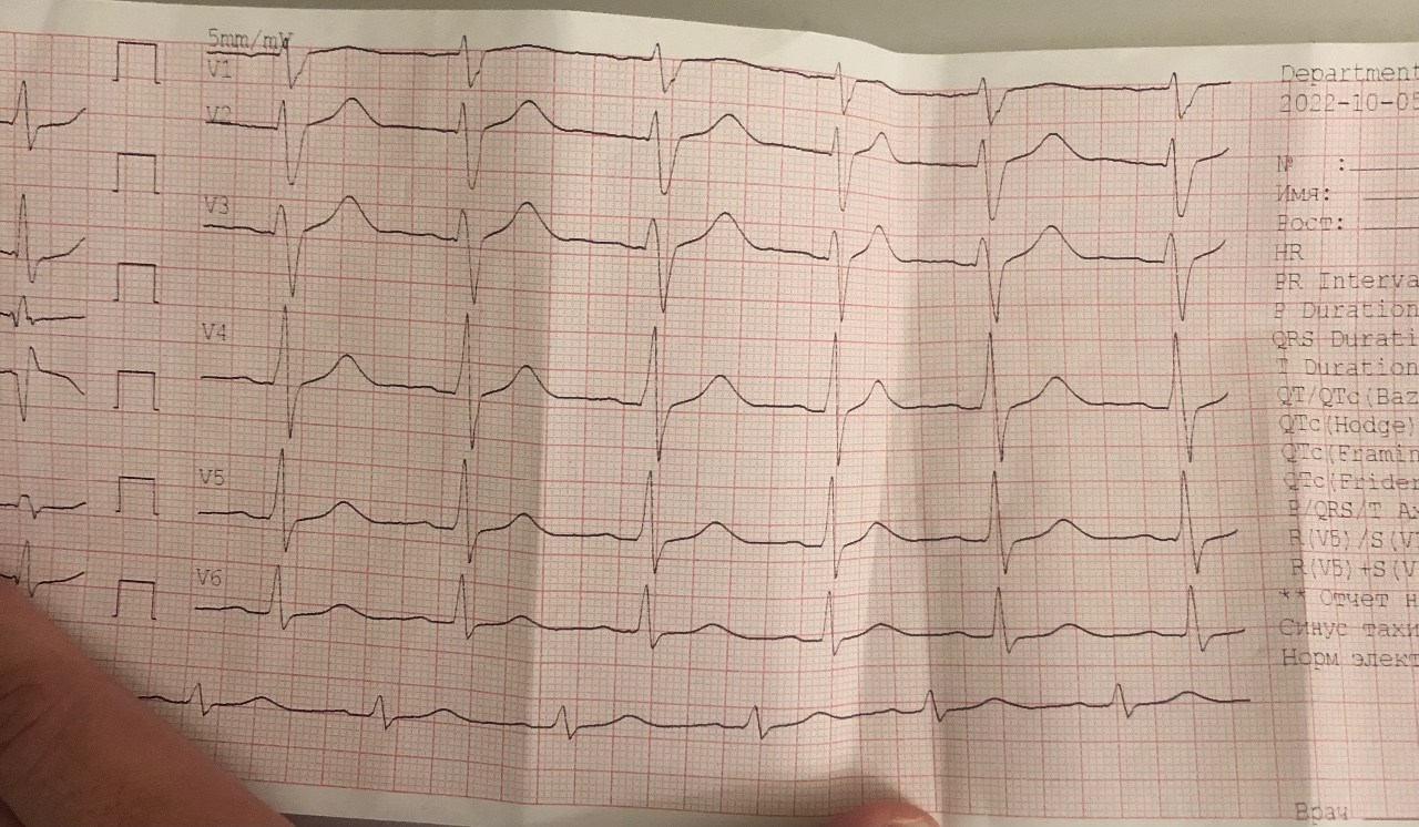 Экг при тахикардии фото